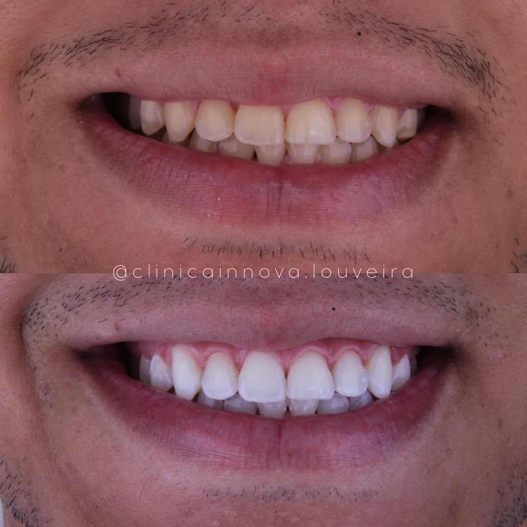 Hoje vamos compartilhar esse caso lindo de clareamento dental! ✨Um procedimento seguro, eficaz q